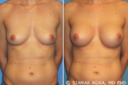 Breast Augmentation