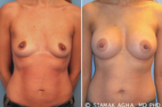 Breast Augmentation