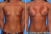 Breast Augmentation