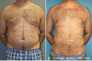 Male Breast Reduction