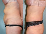 Tummy Tuck