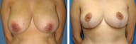 Breast Reduction