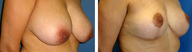 Breast Reduction