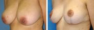 Breast Reduction