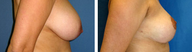 Breast Reduction