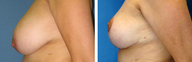 Breast Reduction