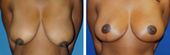 Breast Reduction