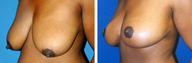 Breast Reduction