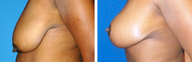 Breast Reduction