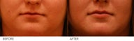 Lip Augmentation