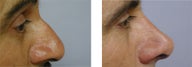 Rhinoplasty