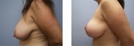 Breast Lift
