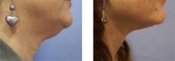 Face and Neck Lift
