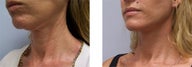 Face and Neck Lift