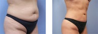 Liposuction