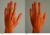 Hand Fat Grafting