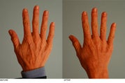 Hand Fat Grafting