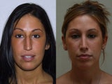 Rhinoplasty