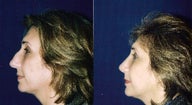 Rhinoplasty