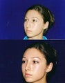 Rhinoplasty