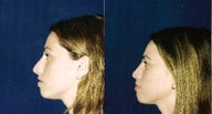Rhinoplasty