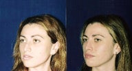 Rhinoplasty