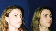 Rhinoplasty
