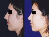 Rhinoplasty