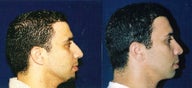 Rhinoplasty