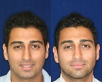 Rhinoplasty and Septoplasty