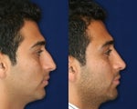 Rhinoplasty and Septoplasty