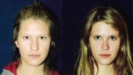 Rhinoplasty 