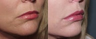 Juvederm Lip Augmentation