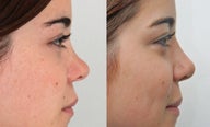 Rhinoplasty