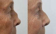 Rhinoplasty