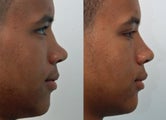 Rhinoplasty