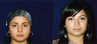 Rhinoplasty 
