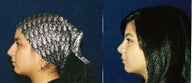 Rhinoplasty