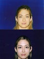 Rhinoplasty