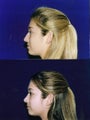Rhinoplasty