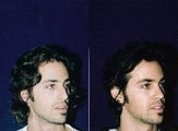 Rhinoplasty and Septoplasty