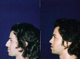 Rhinoplasty and Septoplasty