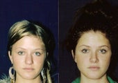 Rhinoplasty