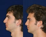 Rhinoplasty