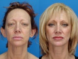 Facelift
