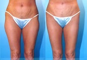 liposuction of thighs
