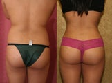 liposuction of back and buttocks contouring