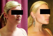 neck liposuction