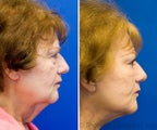 Facelift