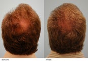 Hair Transplant 